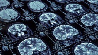 Image of brain scans